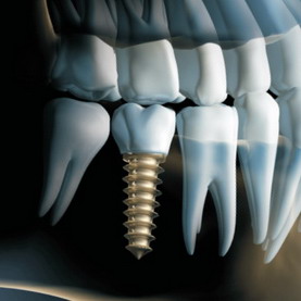 Implantai ir protezavimas