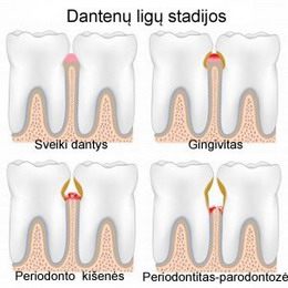 Parodontozė arba periodontitas