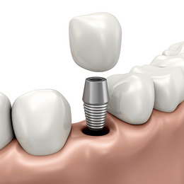 Implantai žmonėms neturintiems dantų
