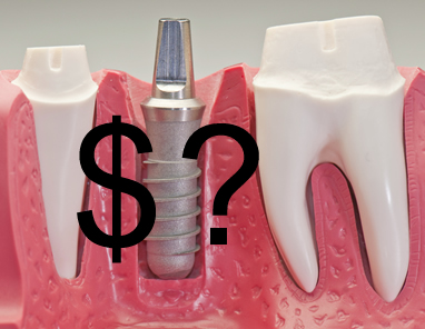 Ką svarbu žinoti apie dantų implantavimo kainą