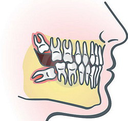 Ką pravartu žinoti apie protinius dantis